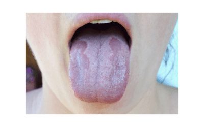 Candida: How to Eliminate it Naturally!