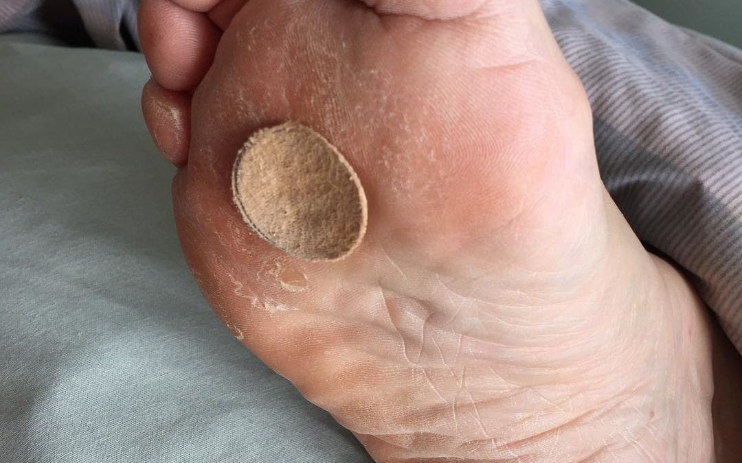 This #foot needs #reflexology badly. Both Feet are in tough shape from wearing pretty #littlesandels all #summerlong. http://dlvr.it/C285lY #foot #reflexology #summerlong #Reflexology #Medfield