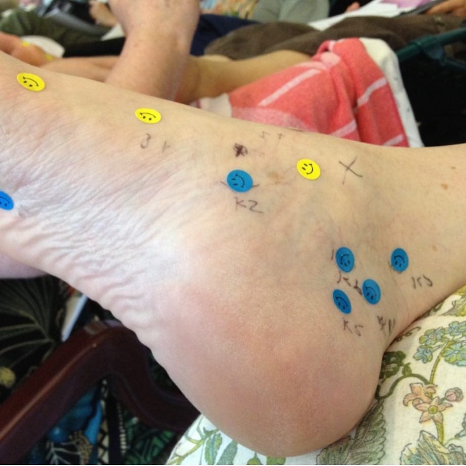 Migraine headache reflexology points