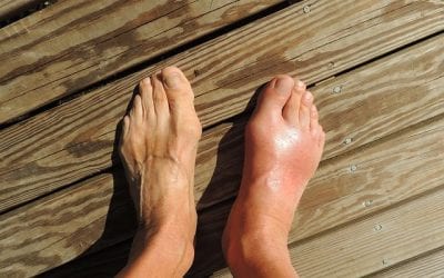 Video: Ease Gout Pain with Foot Reflexology