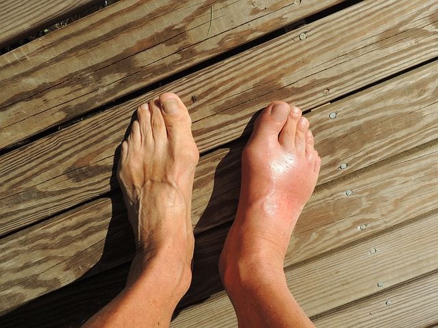 ease-gout-pain-with-foot-reflexology