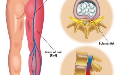 Video: Sciatica Relief with Reflexology