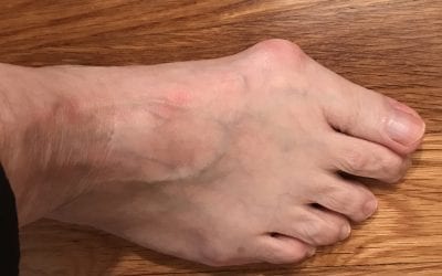 Bunion Pain Relief –  Self Foot Care