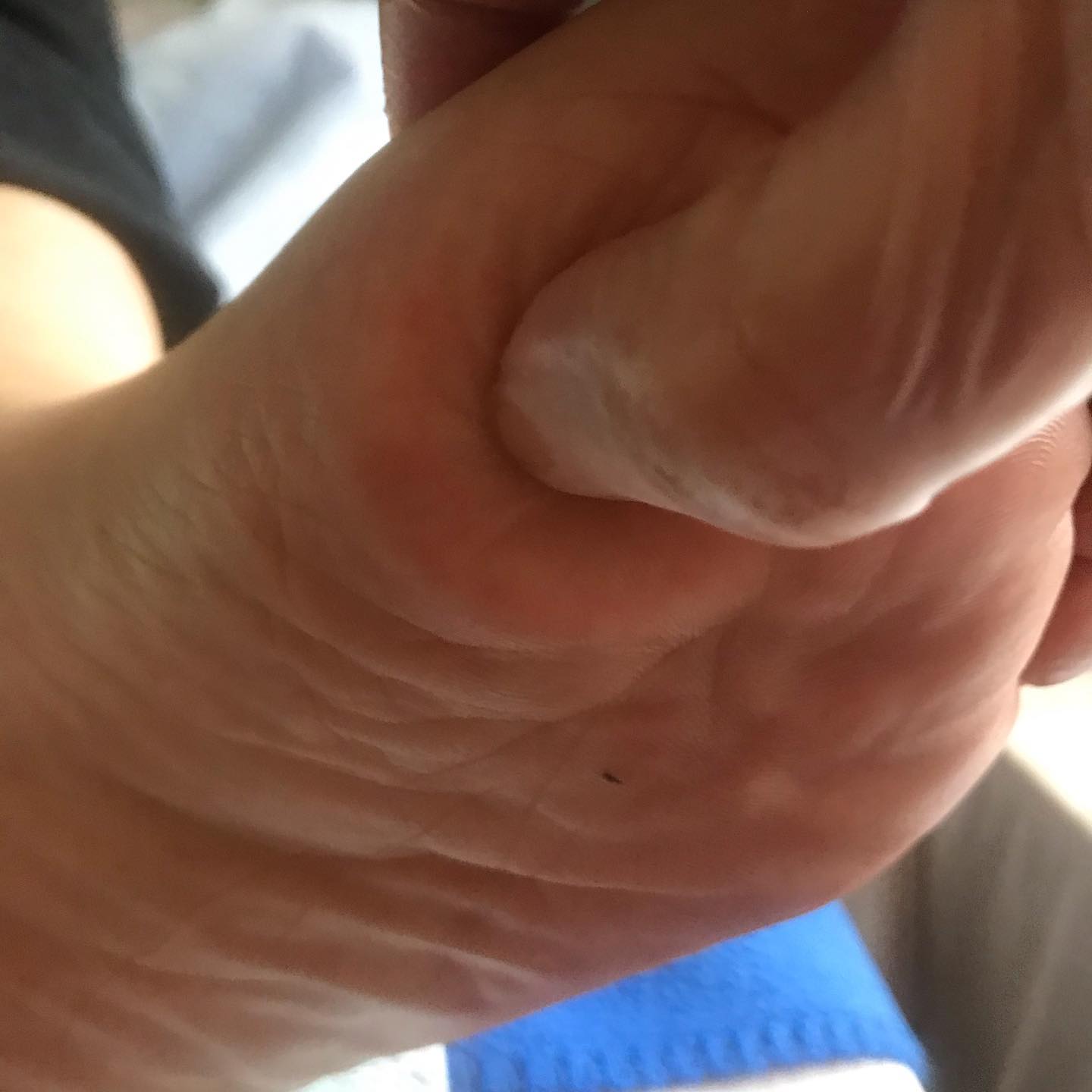 thumb on foot