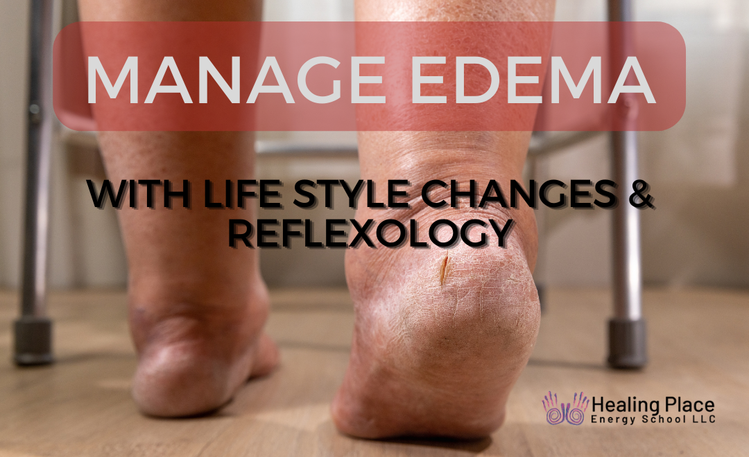 Manage Edema with Life Style Changes and Reflexology #ManageEdema #FootReflexologyforEdema #ReflexologyNearMe #HealingPlaceEnergySchool